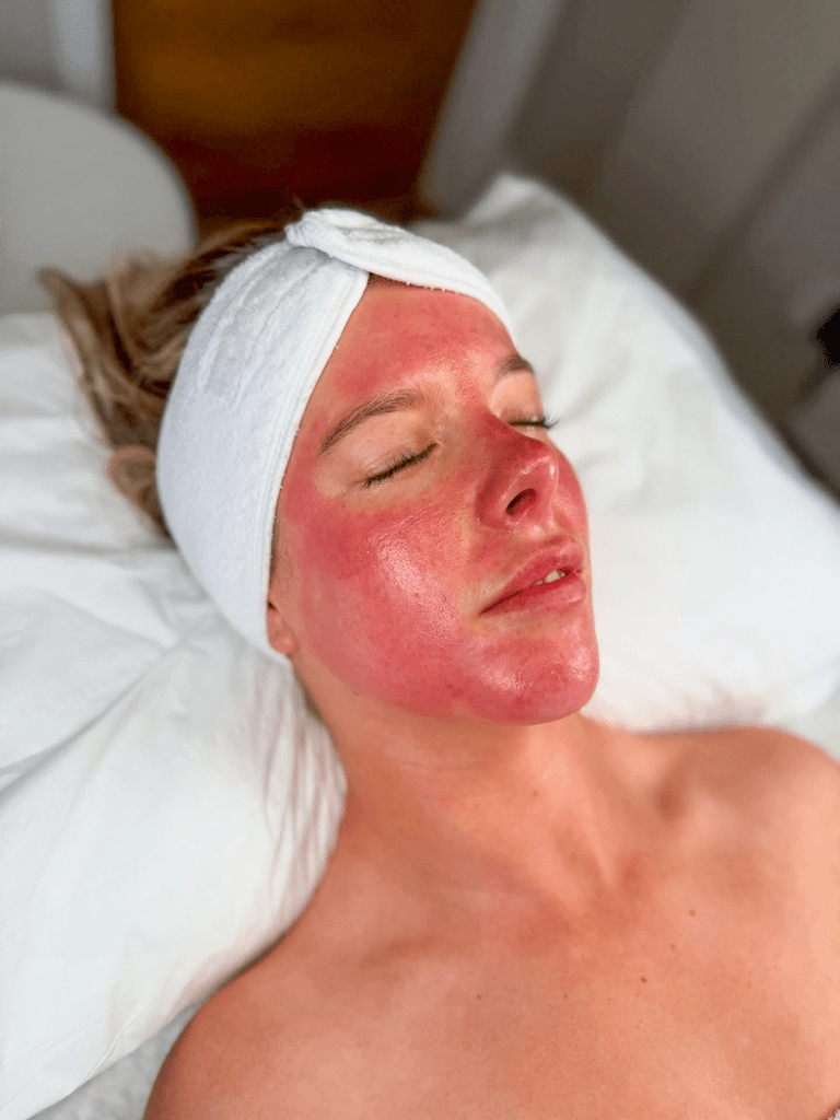 Mikroadatinė procedūra , IG @_skinkind | Treatwell