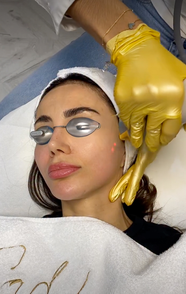 Fotoatjauninimas (IPL), IG @sadaf_jaffari | Treatwell